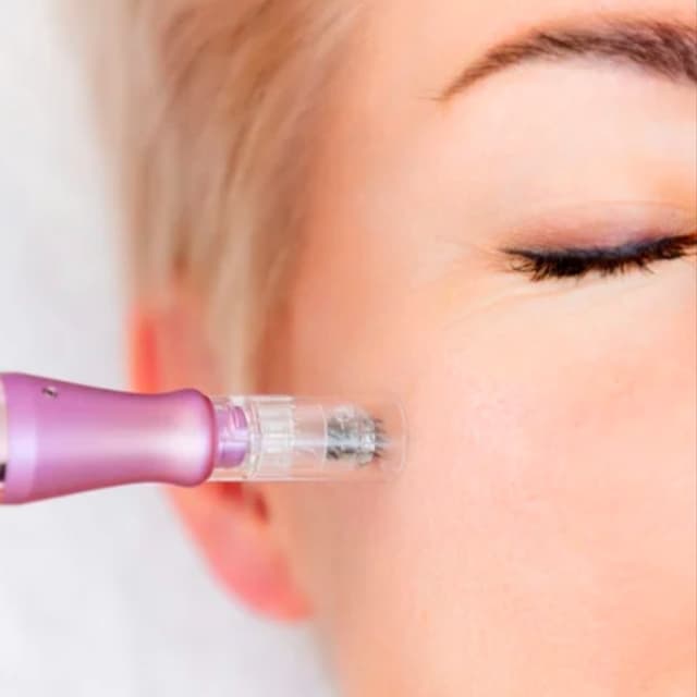Microneedling x3 at The Skin Rendezvous in Mesa, AZ